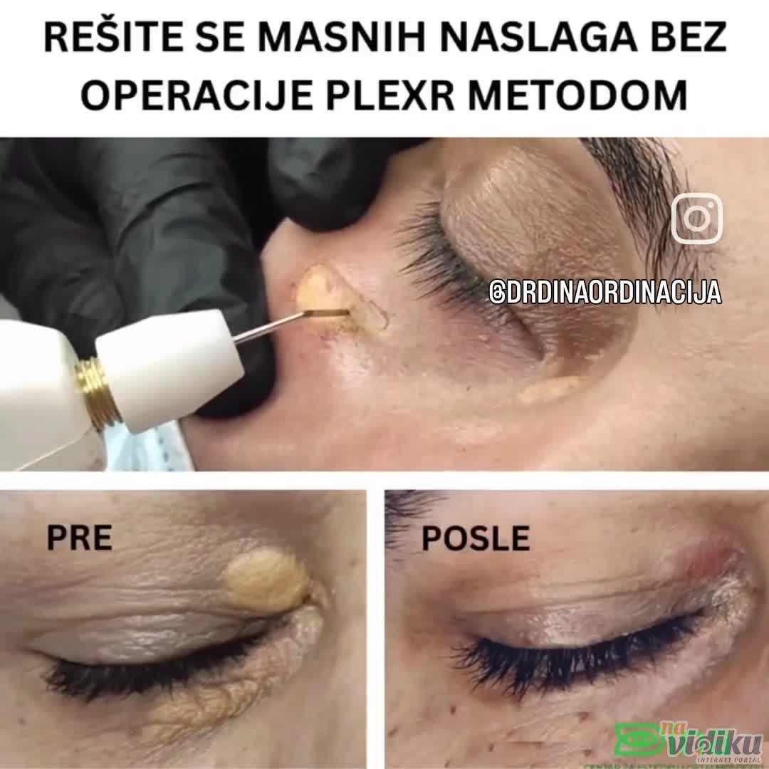 Uklanjanne masnih naslaga oko oka