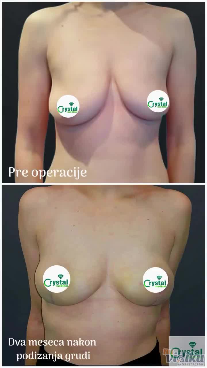 Operacija podizanje grudi