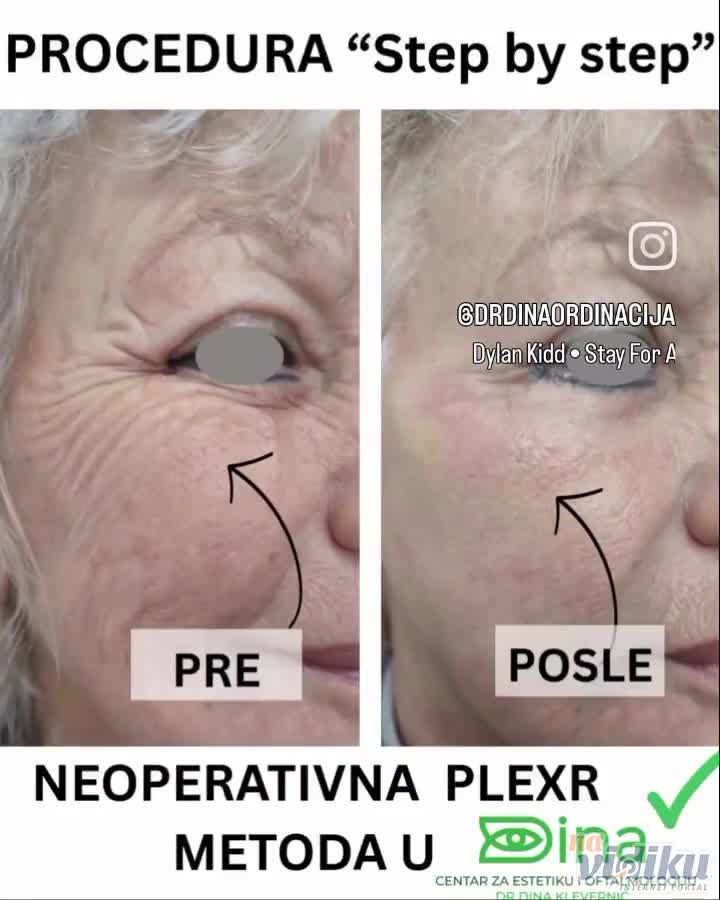 Podmlađivanje regije oko oka