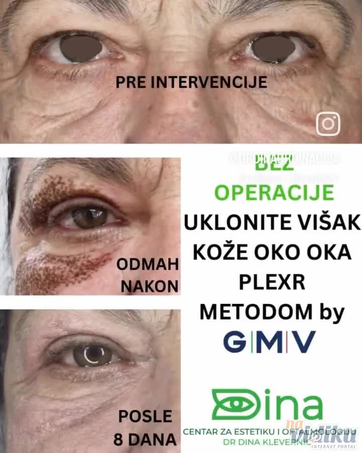 Uklanjanje viška kože na kapcima